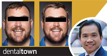 Show Your Work: A Complex Restoration Dr. Sonny Torres Oliva shares a case that restored a 31-year-old patient’s smile using implant-supported crowns, full bridges and onlays. 