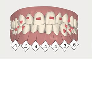 My First Clear Aligner Case A simple first aligner case followed by whitening and composite resin bonding on dental nurse patient