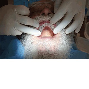 Show Your Work: Guided Implant Surgery (Part 1) In this first of a two-part series, the placement of implants using a surgical guide is detailed with a case illustrating key points