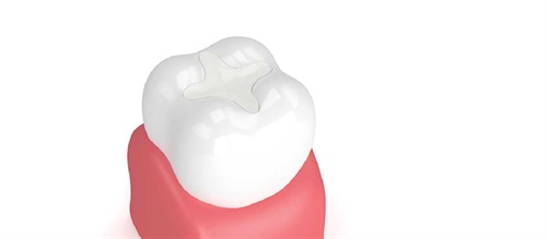 Glass Ionomer Cement Sealants Dentaltown editorial advisory board member Dr. Jeanette MacLean discusses why glass ionomer cement sealants are easier for clinicians and better for patients, then explains the application techniques and key benefits.