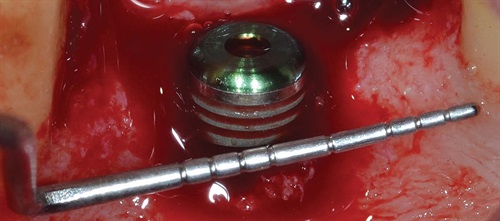 Peri-Implant Guided Bone Regeneration Dr. Giacomo Tarquini’s case study illustrates the use of a novel flex cortical sheet barrier membrane to stabilize the graft and prevent micromovements that could hinder the bone regeneration process. 