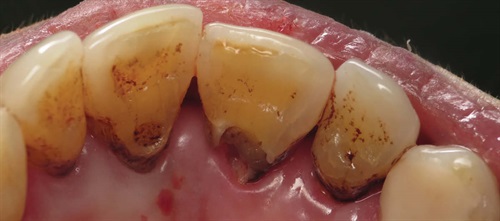 Show Your Work: Restoring Deep Root Caries Dr. Ahmad Fayad shares a conservative technique that mitigates cost barriers without sacrificing patient care.