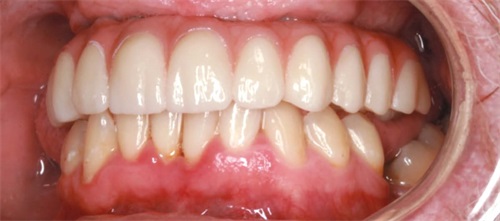 Show Your Work: A Traditional Touch to All-on-X Treatment Dr. Elizabeth DiBona shares an implant case in which she treated a patient whose debilitating dental phobia had led to extensive caries, black staining, bone loss and periodontal disease. Her All-on-X case includes a 2½-year follow-up.