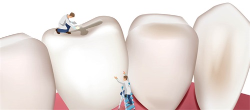 Restorative Choices Drs. Roopwant Kaur and Luis G. Sensi discuss the pluses and minuses of different options for restorative materials after application of silver diamine fluoride, and different approaches for managing any SDF-stained margins.
