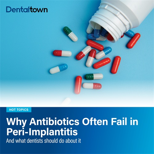 Why Antibiotics Often Fail in Peri-Implantitis New Rutgers research suggests peri-implantitis is not just a bacterial infection. Titanium particles may trap immune cells in attack mode, driving bone loss and explaining why antibiotics fall short.