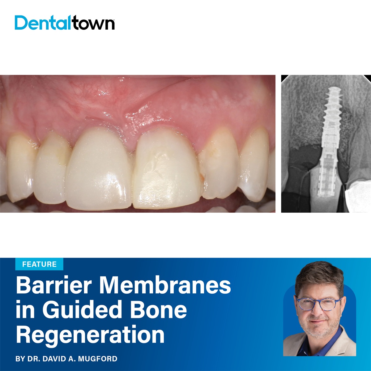Barrier Membranes in Guided Bone Regeneration