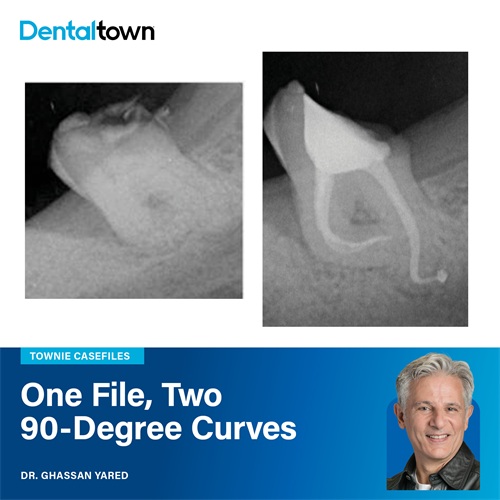 Townie Casefile: One File, Two 90-Degree Curves Dr. Ghassan Yared demonstrates how a single reciprocating file navigated two severely
calcified, 90-degree canals in a mandibular third molar without scouting or a glide path.