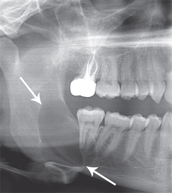 CE: Oral Diseases Associated with Men Hygiene educator Deborah Levin-Goldstein explains the differences among three cysts that most commonly occur in men, and their very different causes and treatments.
