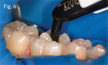 Practice Solutions: 3M How to best use bulk-fill composite in posterior restorations