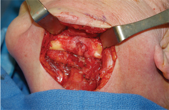 Treatment of  Intraoral Infections Oral and maxillofacial surgeon Samuel L. Bobek recaps the rules that help him focus his thoughts when facing unusual treatment scenarios.