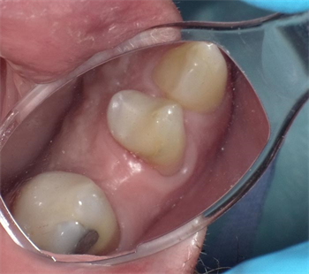Bioactive Materials Dr. John Comisi discusses bioactive resin bonding materials for direct restorations and shares three case studies.