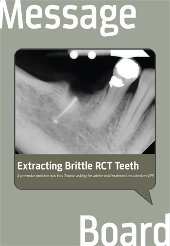 Extracting Brittle RCT Teeth A premolar problem has this Townie asking for advice midtreatment on a broken #29.
