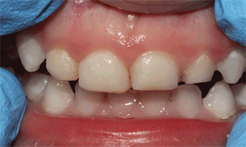 Adhesion in Primary Dentition  Restorative Dentistry 