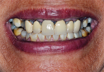 The Power of Smile Design The first installment of delivering the perfect smile focuses on patient expectation and treatment planning for aesthetic success