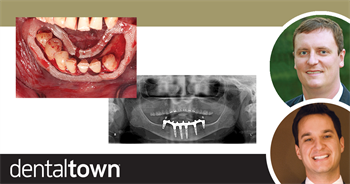 Advanced Full-Arch  Implant Surgery Drs. Cory Glenn and Danny Domingue discuss a full-arch implant case that used a surgical guide 3D printed in the dental practice, and compare the case’s accuracy to a similar one performed without such a guide.
