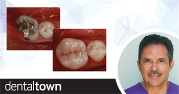 Can We Fix It? Dr. Isaias Íñiguez shares a case of direct cusp reconstruction using composite pins.