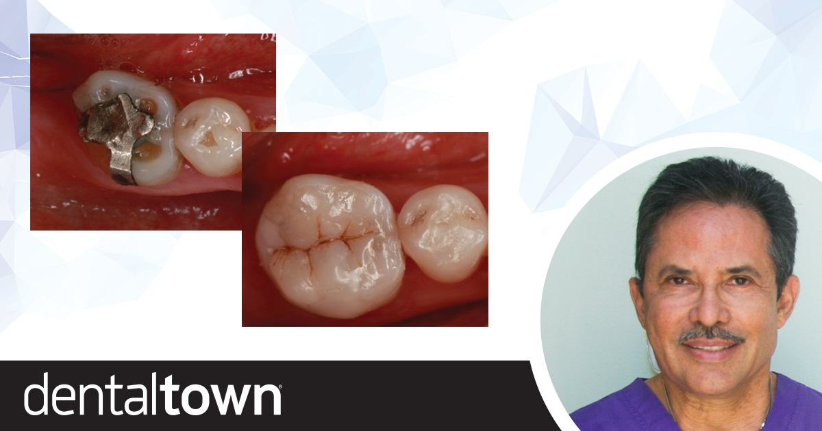 Can We Fix It? Dr. Isaias Íñiguez shares a case of direct cusp reconstruction using composite pins.