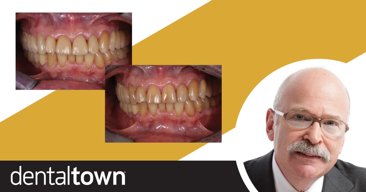 Show Your Work: Efficient treatment Using a Digital Workflow Dr. Jonathan L. Ferencz demonstrates how a digital workflow and in-office CAD/CAM technology can help dentists create provisionals and treatments for multiple single-unit restorations in only two clinical visits.