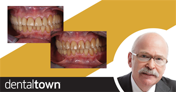 Show Your Work: Efficient treatment Using a Digital Workflow Dr. Jonathan L. Ferencz demonstrates how a digital workflow and in-office CAD/CAM technology can help dentists create provisionals and treatments for multiple single-unit restorations in only two clinical visits.