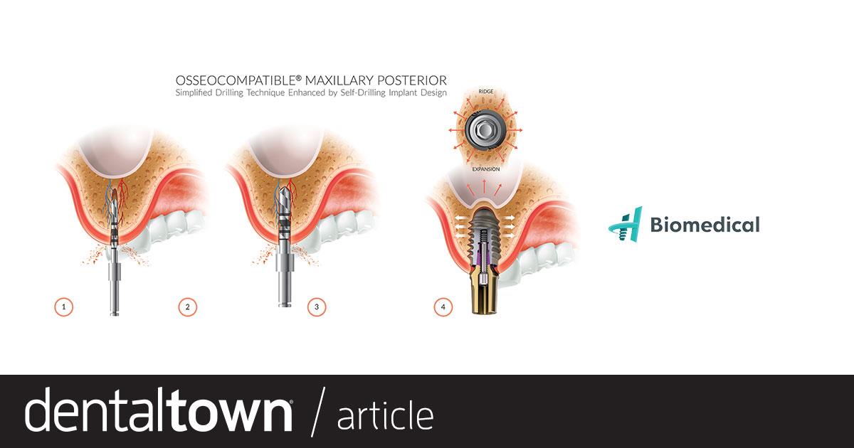 Product Profile: Osseocompatible Implant Systems A new age of dental implants