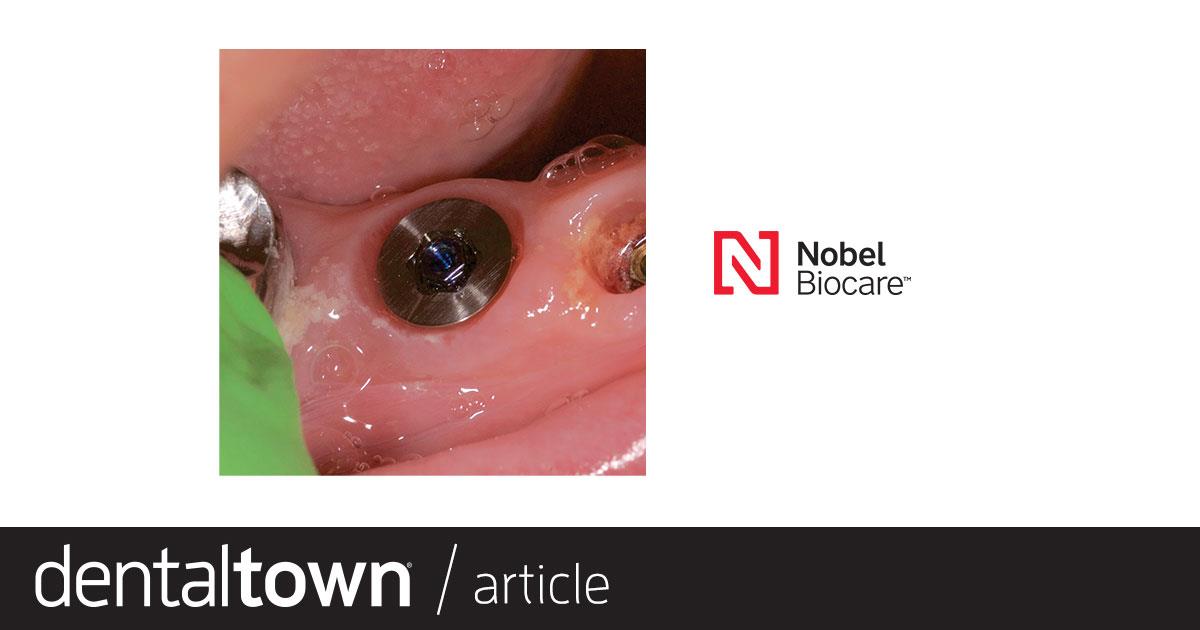 Product Profile: On1 Concept Simpler crowns, predictable outcomes