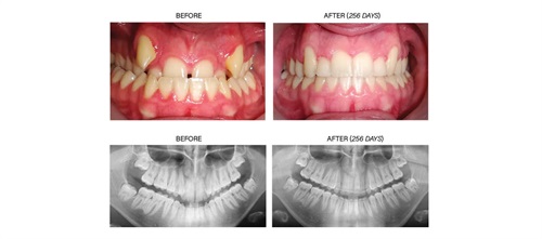Product Profile: Fastbraces The cupping depth of the alveolar bone