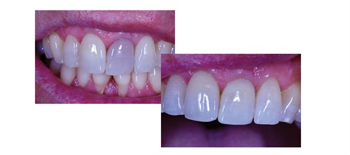 Bleaching Discolored Endodontically Treated Teeth Dr. Terry Shaw, one of the most-followed members on Dentaltown’s message boards, discusses how he approaches the treatment of endodontically treated discolored teeth, and shares three case studies illustrating his steps and successes.
