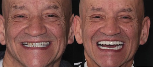 Show Your Work: Bytes Create Bites Dr. Steven Glassman and Ryan Wagner share a case study that involved a digital workflow to create a new denture for a patient who’d fractured his old one.