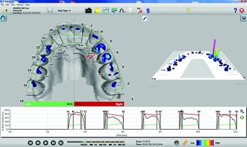 A Review of Digital Occlusal Analysis Technologies