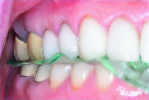 A Review of Digital Occlusal Analysis Technologies