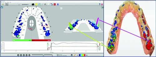 A Review of Digital Occlusal Analysis Technologies