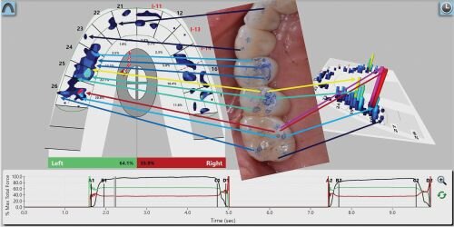 A Review of Digital Occlusal Analysis Technologies