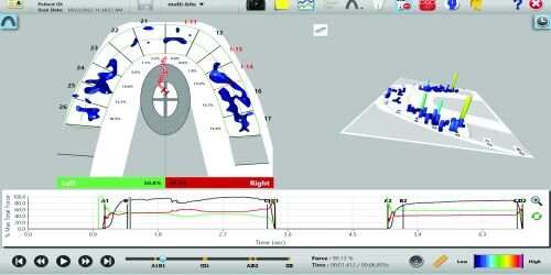 A Review of Digital Occlusal Analysis Technologies