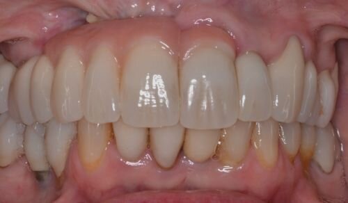 A Review of Digital Occlusal Analysis Technologies