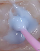 Case Report: Microbrush Stamp Technique Dr. K. Varsha Rao uses this simple yet effective process to restore posterior teeth with composite material.