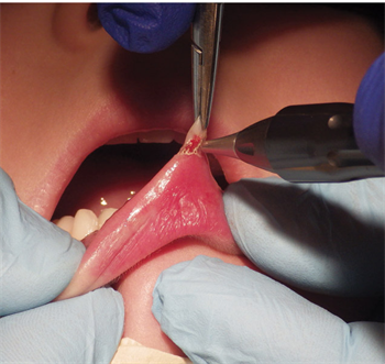 CE: Laser Mucocele Removal in Pediatric Patients Drs. Robert Levine and Peter Vitruk on using SuperPulse lasers to treat mucoceles.