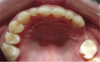 A Complex Restorative Case Dr. Ehab Rashed shares the orthodontic adjustment and surgical intervention that lit a megawatt smile for this patient