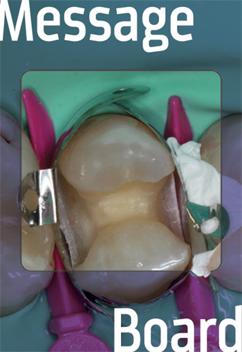 A Quad of Composites Take a look at this detailed case on an extremely caries-prone patient. 