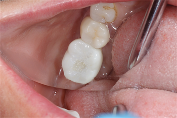 Show Your Work: When Plans Go Awry Dr. Jordan Sanders shares an implant case involving a patient who couldn’t open wide enough to accommodate the surgical guide or osteotomy drills and how the case proceeded from there.
