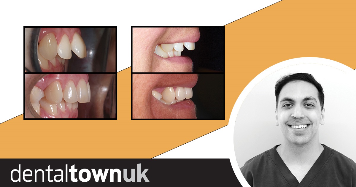 ABB Smile Makeover Dr Salman Siddiqi shares an Anterior Alignment Orthodontic case.