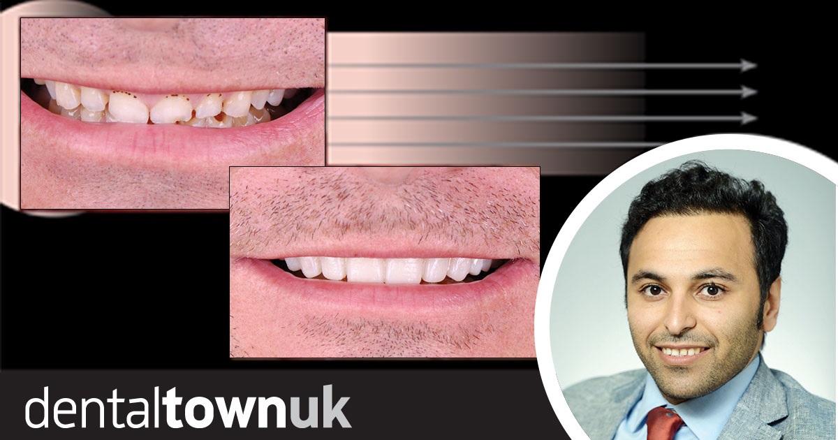 Show Your Work: Aesthetic Crown  Lengthening Dr Abdullah Alkanan outlines the procedural approach and importance of planning and interdisciplinary communication in this aesthetic crown lengthening case.
