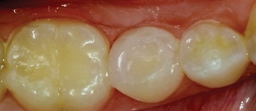 Show Your Work: Warm Up to Something New Dr. Ron Kaminer illustrates the use of a thermoviscous nanohybrid composite that was developed specifically to be heated for ease of placement in a bulk fashion.