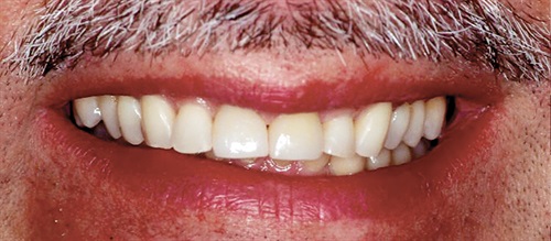 Show Your Work: Minimally Restoring Severe Tooth Surface Loss Dr. Joe Whitehouse shares a case study of a patient whose tooth surface loss was treated using minimally invasive techniques. Instead of removing even more enamel, he started with orthodontics to move the teeth into better position to receive three-quarter wrapped restorations.