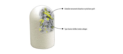 Product Profile: OsteoGen Bone Grafting Plug One-step bone grafting solution for socket preservation without a membrane from Impladent
