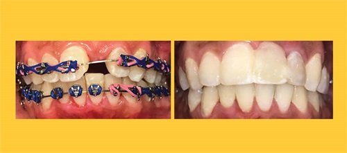 Product Profile: Fastbraces Making spaces for implants in about 100 days