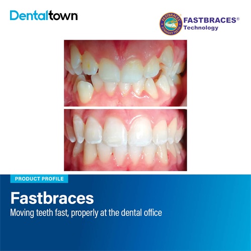 Product Profile: Fastbraces Moving teeth fast, properly at the dental office