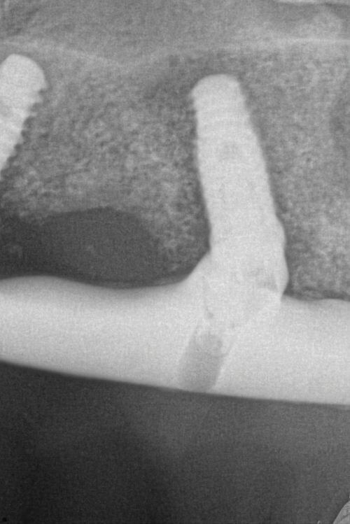 Calibrating Full-Arch Immediate Prosthetics with Condylar Centric in the Digital Era