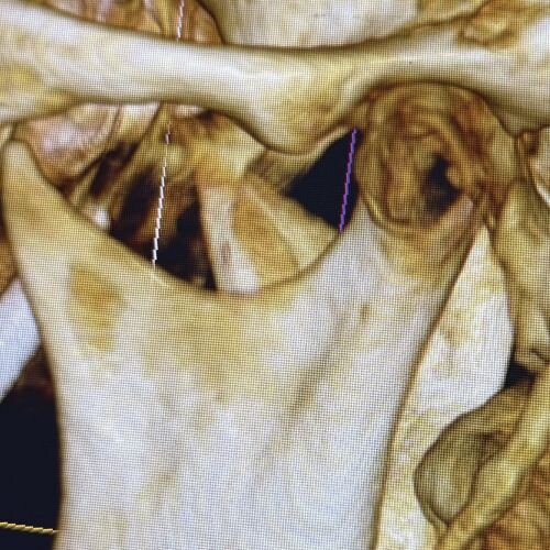 Calibrating Full-Arch Immediate Prosthetics with Condylar Centric in the Digital Era