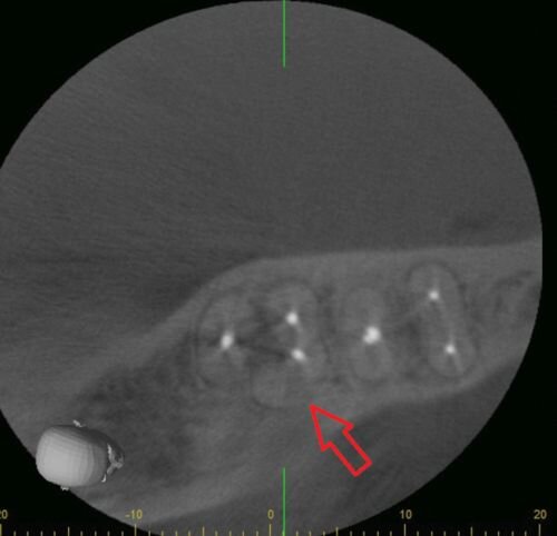 Case Profile: Navigating a Radix Paramolaris