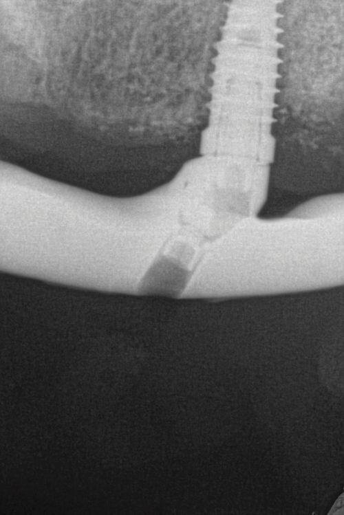 Calibrating Full-Arch Immediate Prosthetics with Condylar Centric in the Digital Era